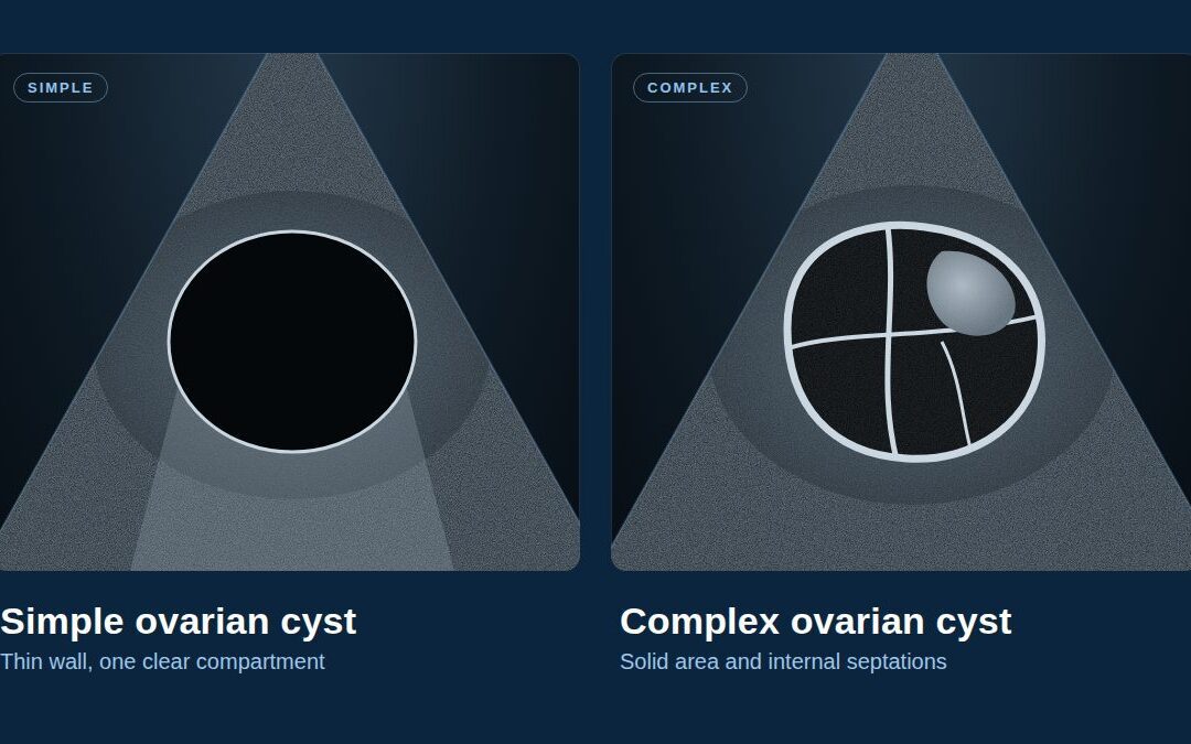 Ovarian Cysts: Which Ones Need Treating and Which Can Safely Be Left Alone
