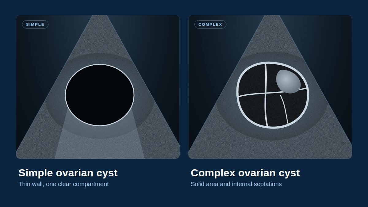 Ultrasound comparison of a simple ovarian cyst and a complex ovarian cyst